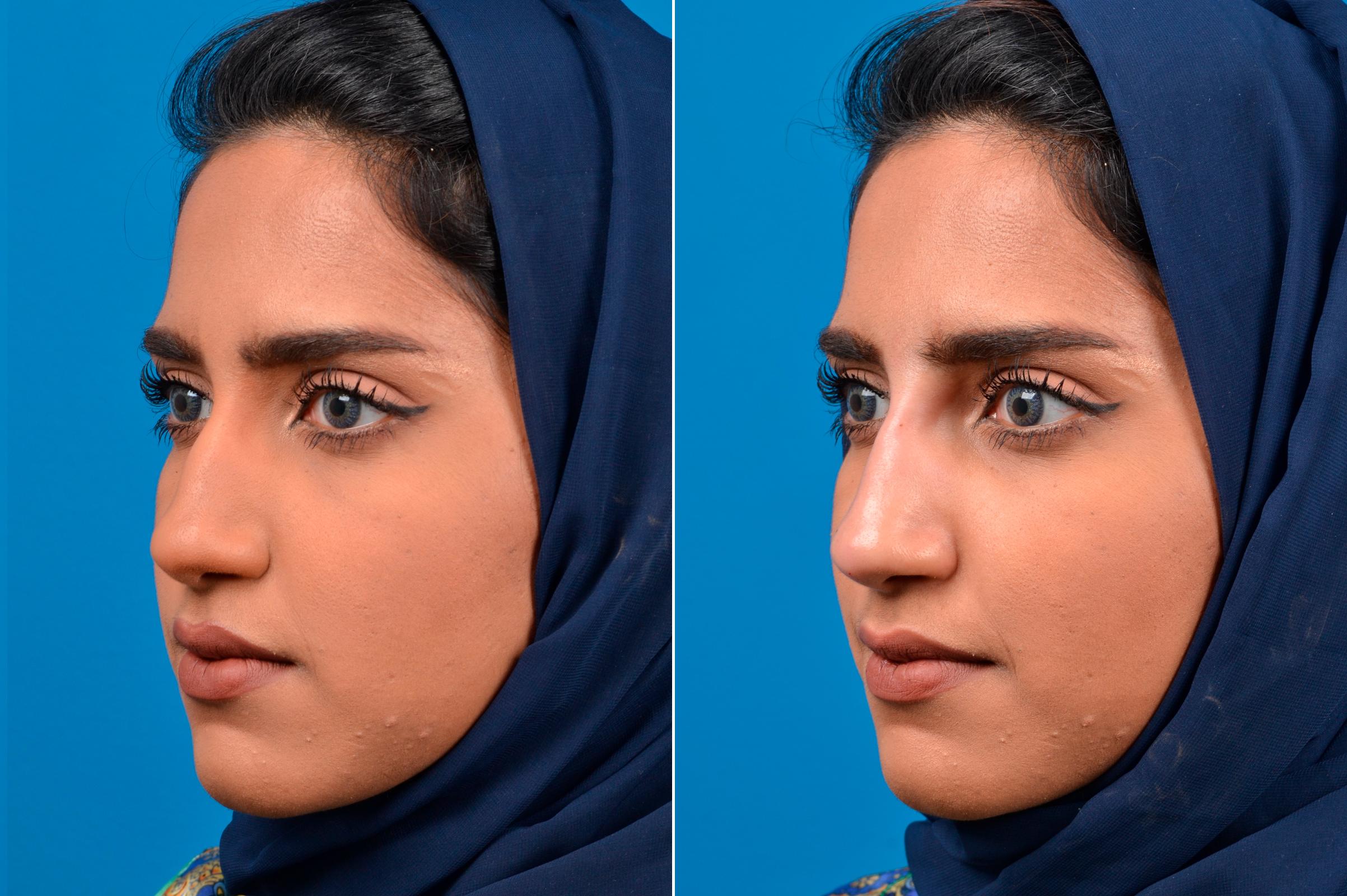 Rhinoplasty before and after